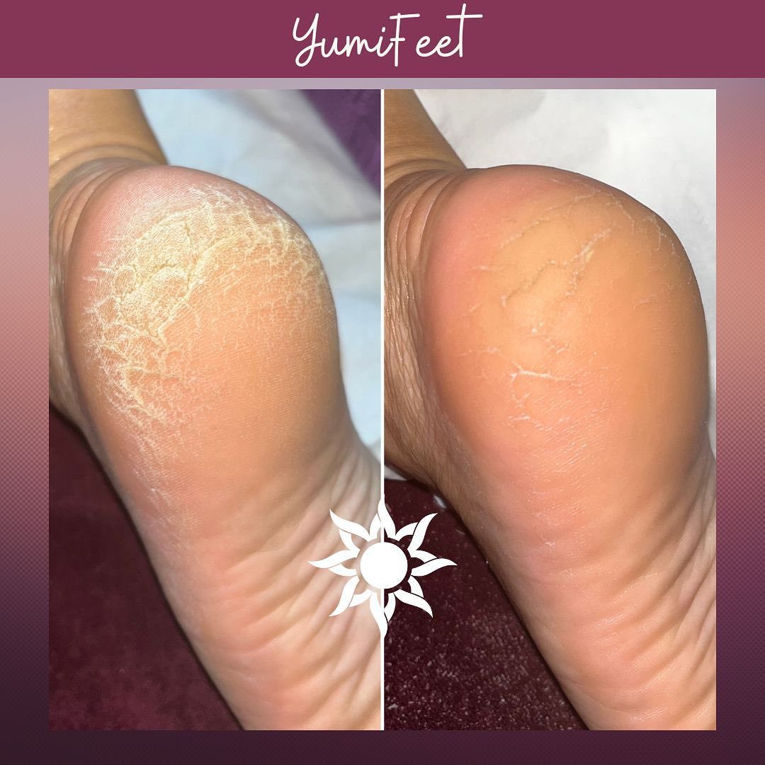 YumiFeet, le soin anti callosité pour de jolies pieds 🥰
(Résultat après 1 soin 😊)