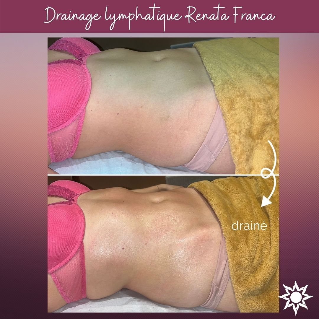 Résultat sur le ventre après 1 séance de drainage lymphatique Renata Franca 🌸
